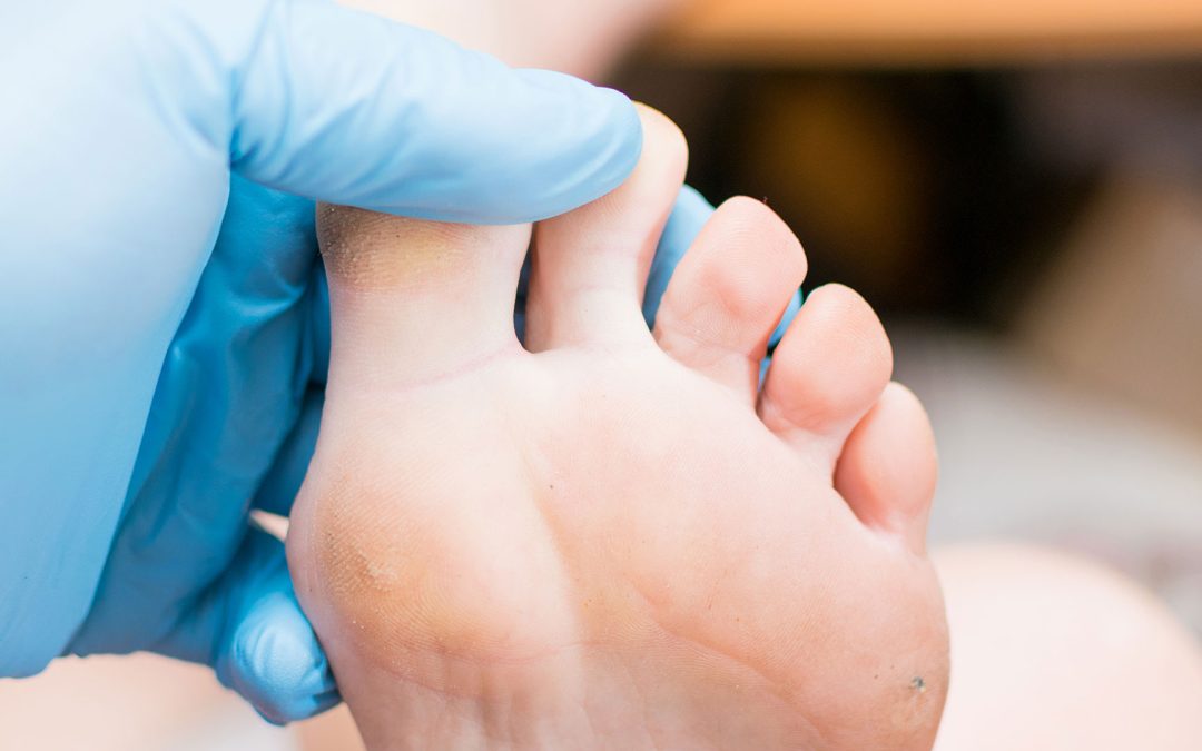 Does Medicare cover bunion surgery?