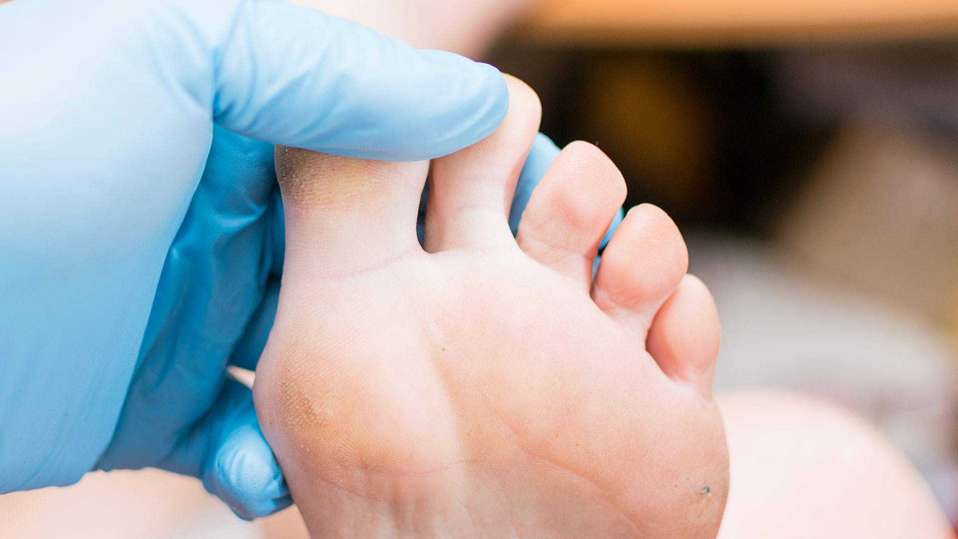Does-Medicare-cover-bunion-surgery